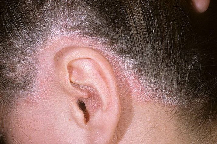 Erupce psoriázy na hlavě za ušima