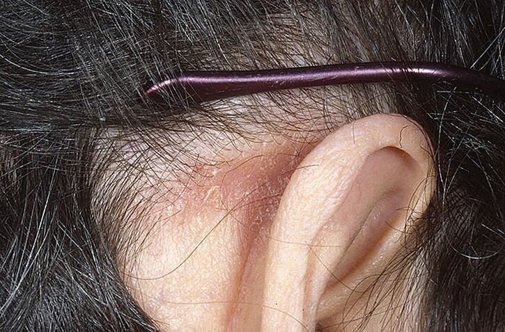 Psoriatický plak za uchem