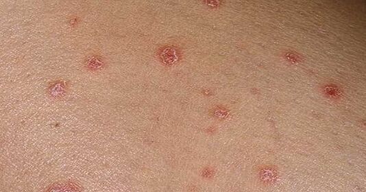 Psoriatické plaky