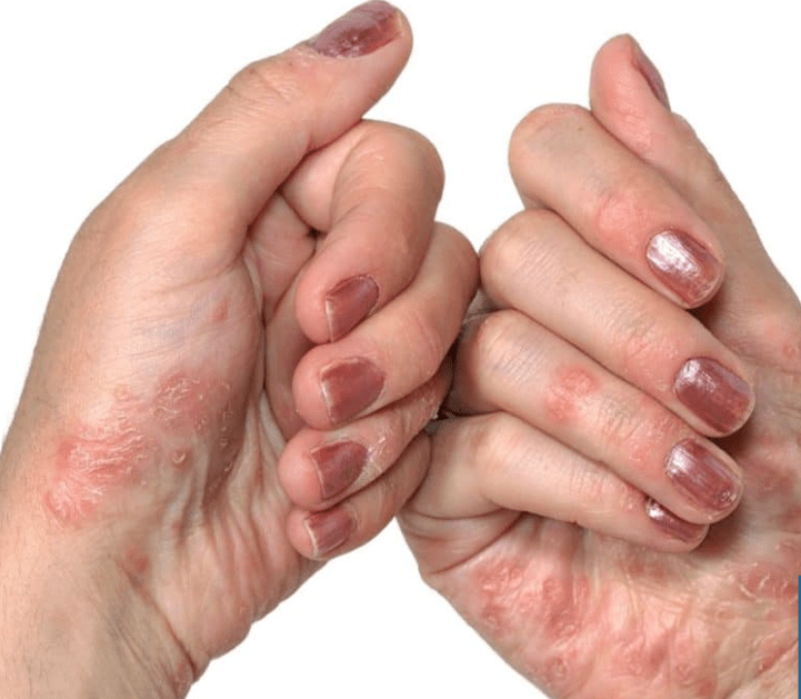 Psoriáza v rukou