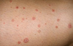 Psoriatické plaky