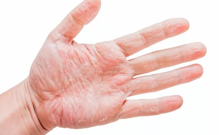 Psoriáza