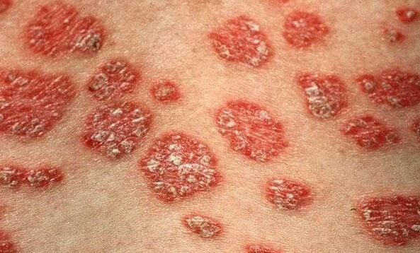 Formy psoriázy