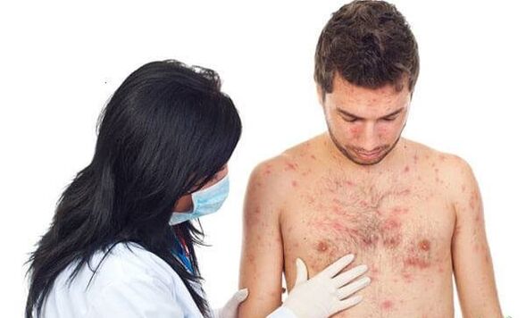 Psoriáza Foto