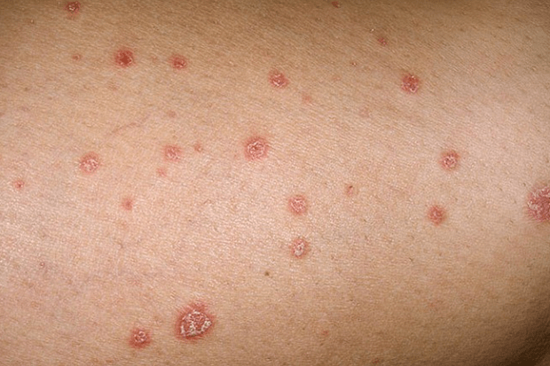 Psoriatické plaky