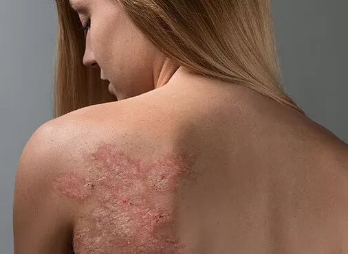 Psoriáza na dívčích zádech
