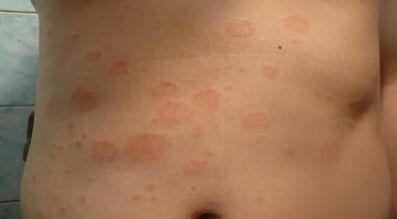 jak rozpoznat počáteční fázi psoriázy