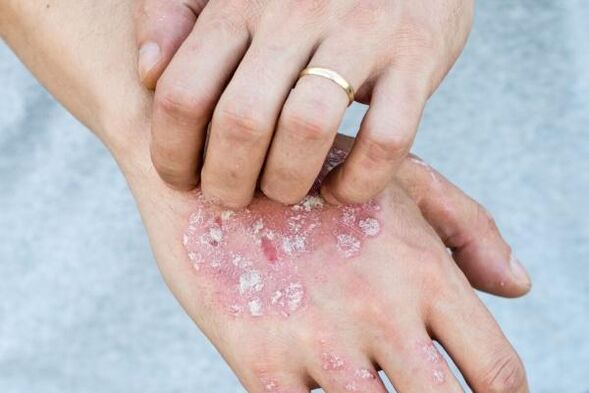 charakteristické příznaky psoriázy na rukou