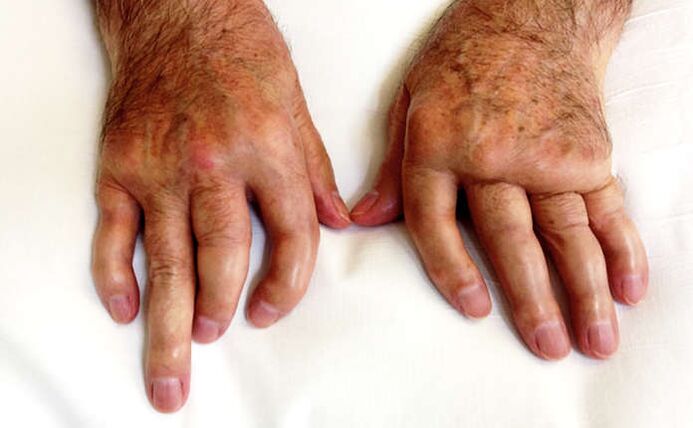 Mutační artritida u psoriázy