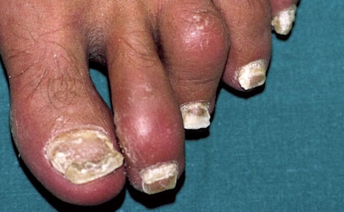 Psoriáza s postižením nehtů a zánětem kloubů (artritida) prstů na nohou